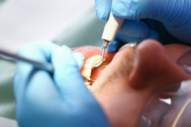 Best Emergency Dentist for Lost Fillings or Crowns in Capron, IL