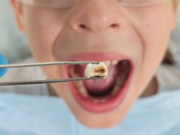 Best Emergency Dentist for Knocked-Out Tooth in Capron, IL